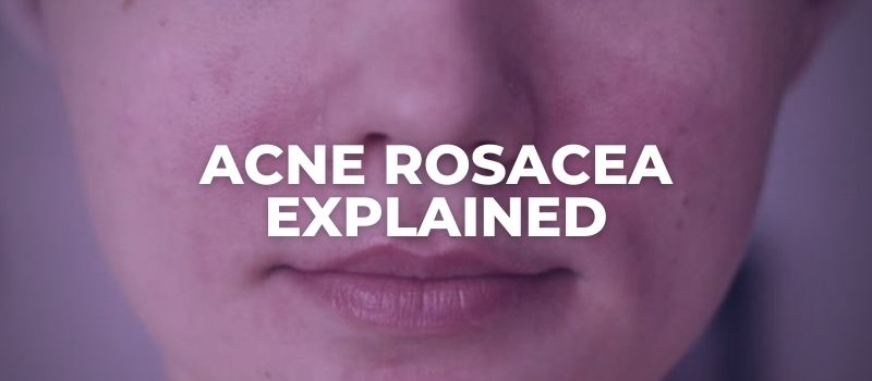 acne rosacea explained