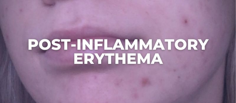 how to treat Post-Inflammatory Erythema