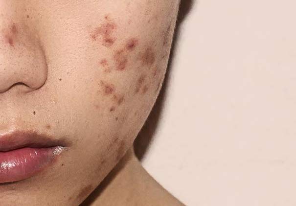 what-is-post-inflammatory-pigmentation-pih-in-skincare