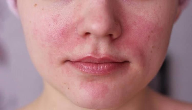 what is acne rosacea