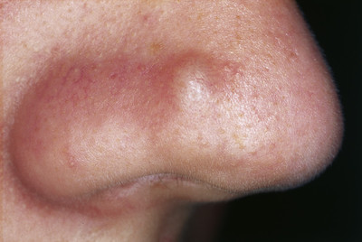 Papules