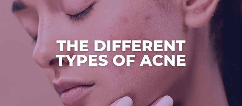 THE DIFFERENT TYPES OF ACNE