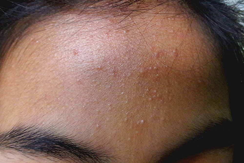 acne mechanica