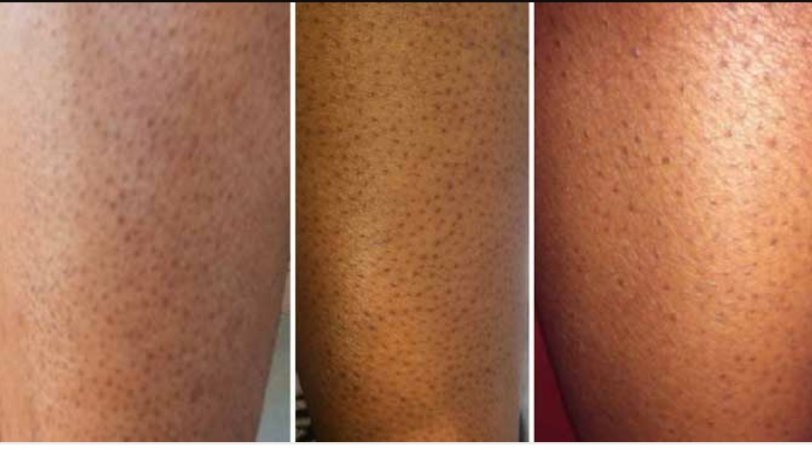 How To Get Rid Of Strawberry Legs 