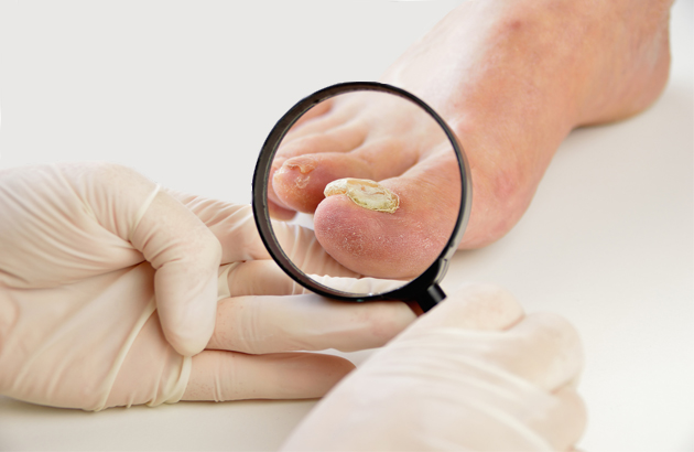 if you have a fungal infection visit a doctor