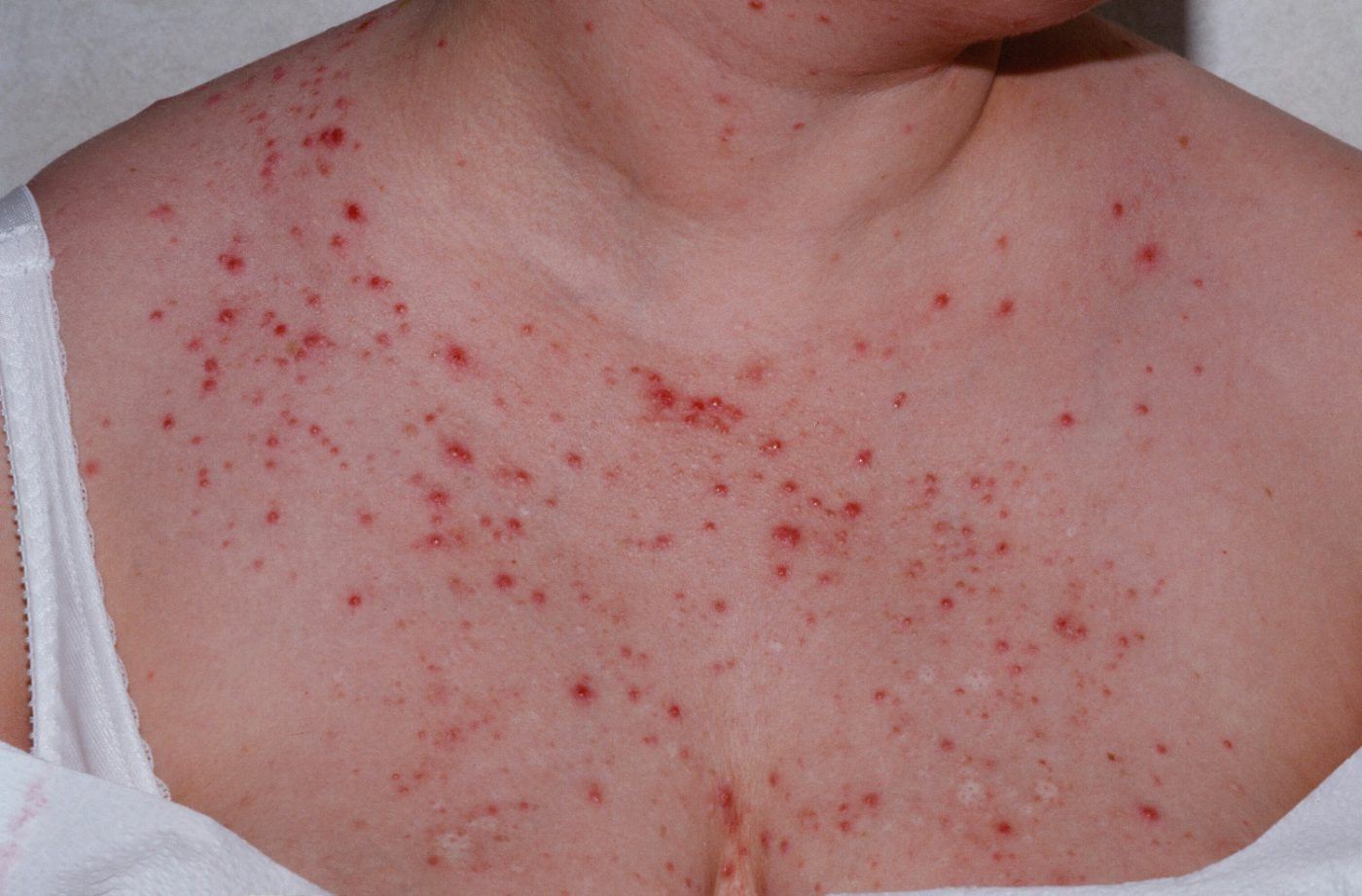 What Is Malassezia Folliculitis How You Can Treat It