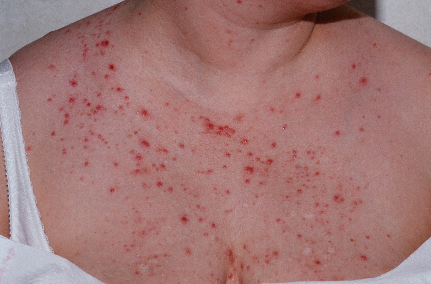 types of Malassezia Folliculitis