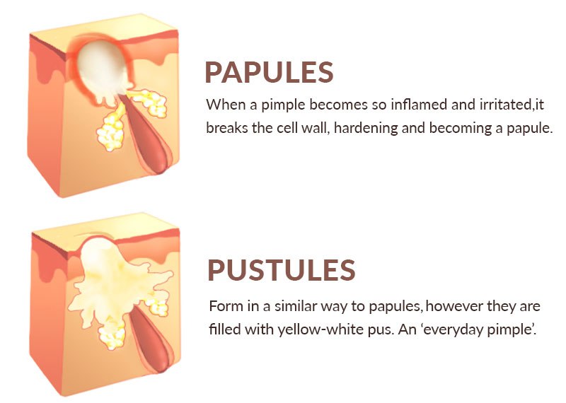 difference between papules and pustules