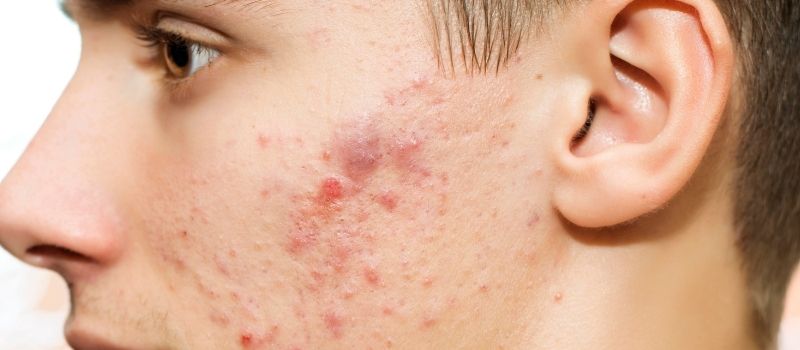 what really causes acne