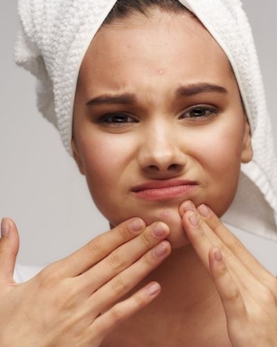 How To Get Rid Of stress caused Acne