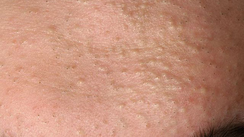 what is subclinical acne