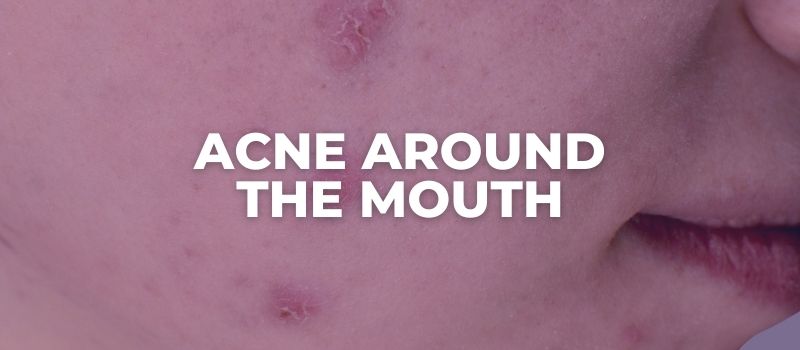ACNE AROUND THE MOUTH