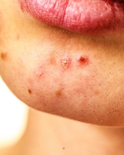 What Do Chin Acne Breakouts Mean