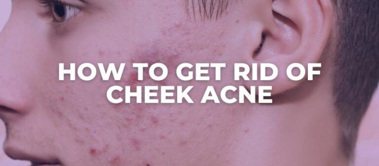 How To Get Rid Of Cheek Acne An Esthetician Explains 1583