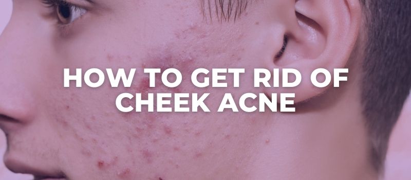 how to get rid of cheek acne