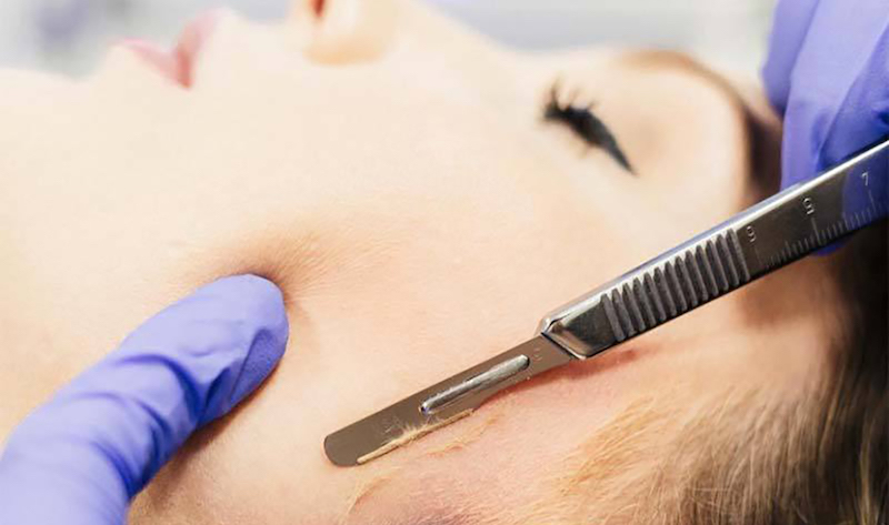 how to do Dermaplaning at home safely