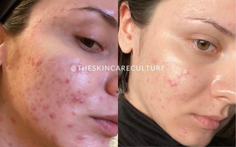 How To Heal Cystic Acne Naturally