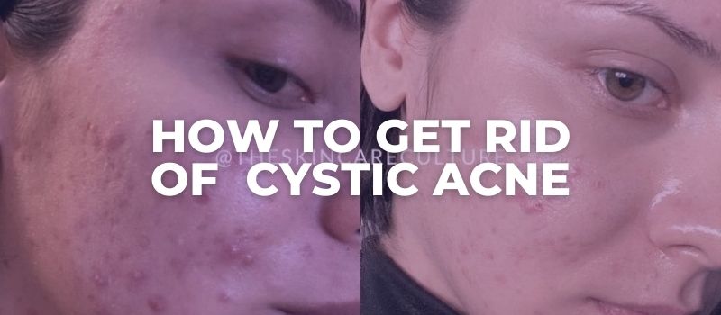 how to get rid of cystic acne