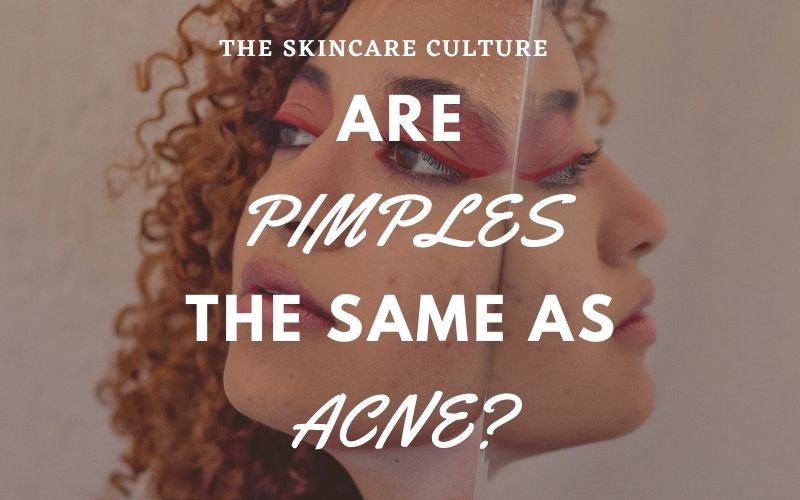 Are Pimples The Same As Acne