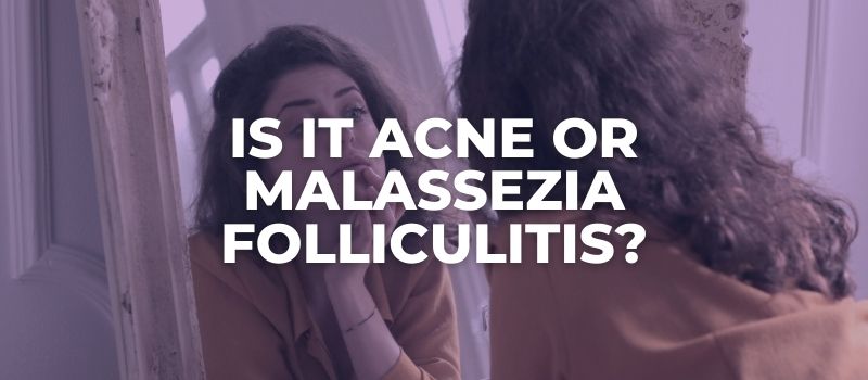 Is it Acne or Malassezia Folliculitis?