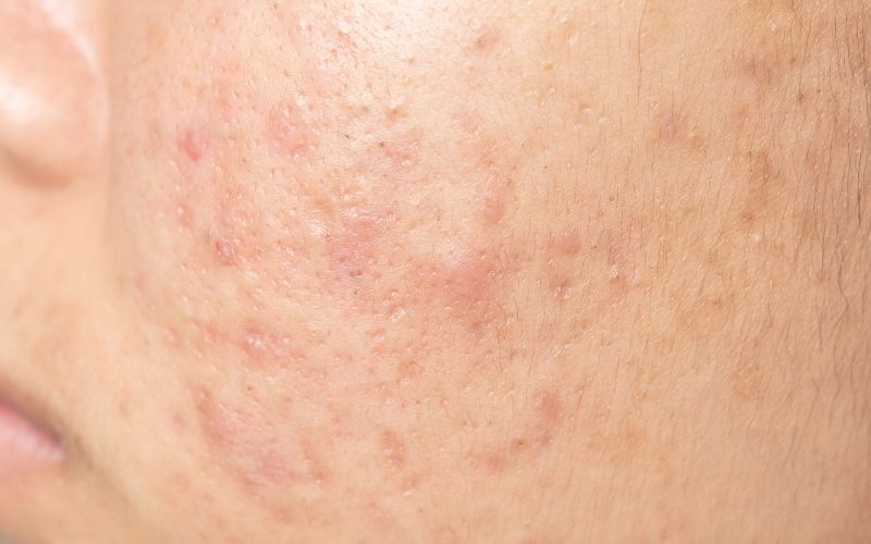 Can Exfoliating Help With Acne Scars?