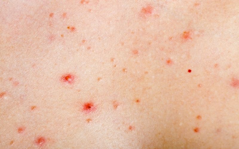 What Hormone Causes Chest Acne