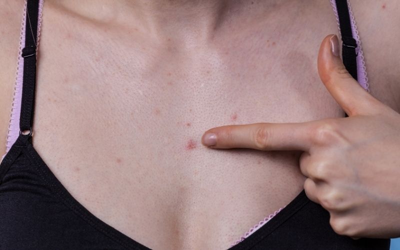 What Causes Chest Acne