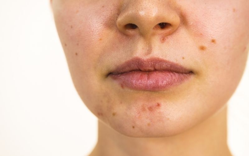 aging acne prone skin