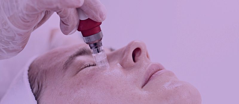 Can You do Microneedling While on Accutane - The Skincare Culture