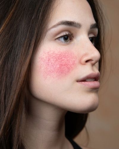 Risks of Mixing Benzoyl Peroxide and Tretinoin - The Skincare Culture