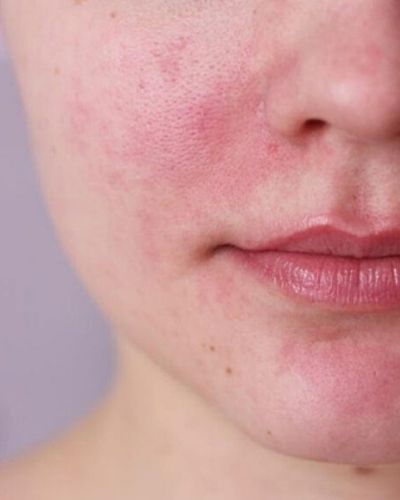 Alternative Treatments for Rosacea - The Skincare Culture