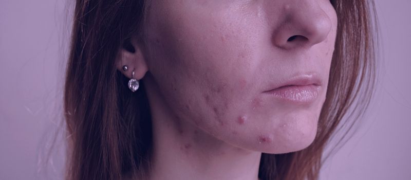 Is Tretinoin Good for Cystic Acne - The Skincare Culture