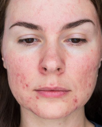 Side Effects of Using Tretinoin for Rosacea - The Skincare Culture