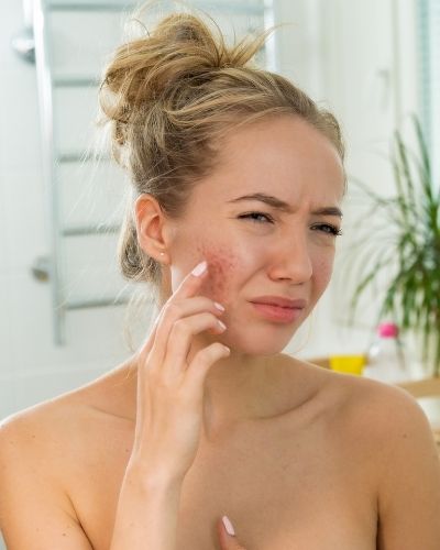 Side Effects of Using Tretinoin for Treating Cystic Acne - The Skincare Culture