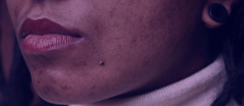Will Accutane Help With Acne Scarring - The Skincare Culture