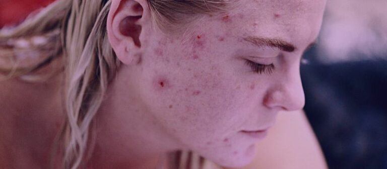 Is Accutane Good For Hormonal Acne   Is Accutane Good For Hormonal Acne The Skincare Culture 768x336 