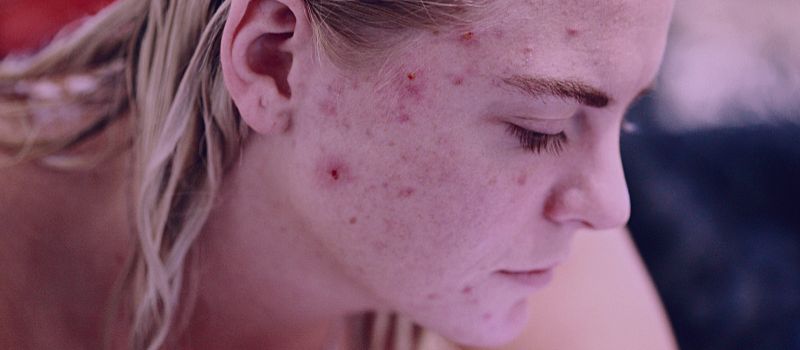 Is Accutane Good for Hormonal Acne - The Skincare Culture