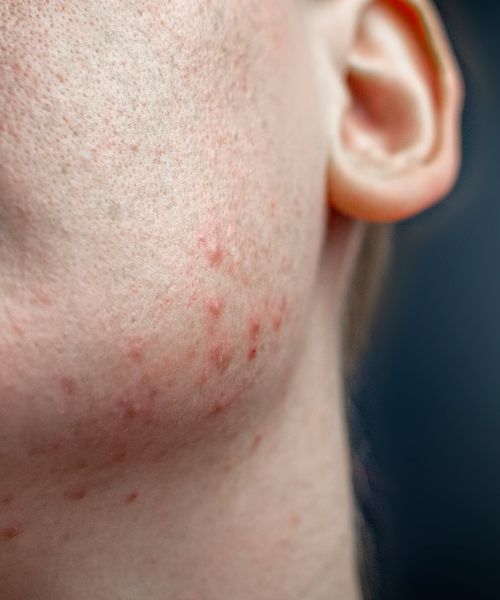 What Does Hyperthyroidism Acne Look Like