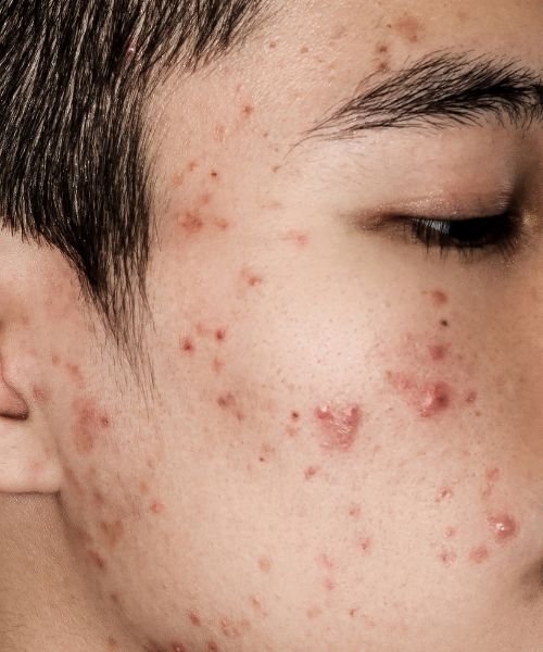 Why Does Acne Itch and how can you sooth it