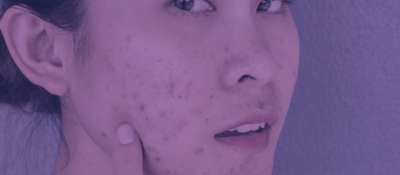 can Adapalene Gel heal Acne Scars