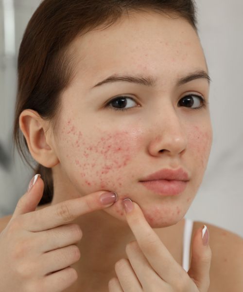 which is better for acne?
