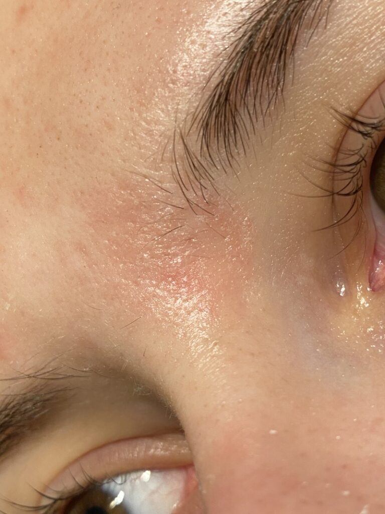 Can Retinol Cause Eczema?