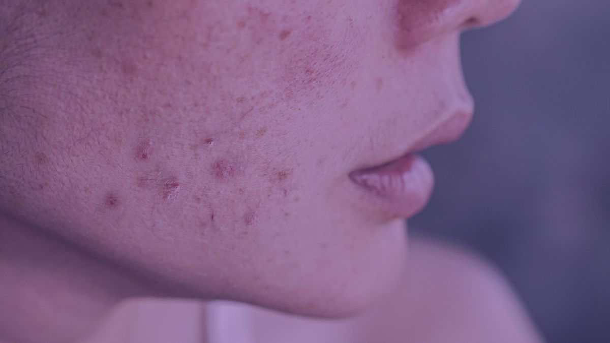 The face of a woman with a full face of acne who has been doing very common skincare mistakes described in this article.