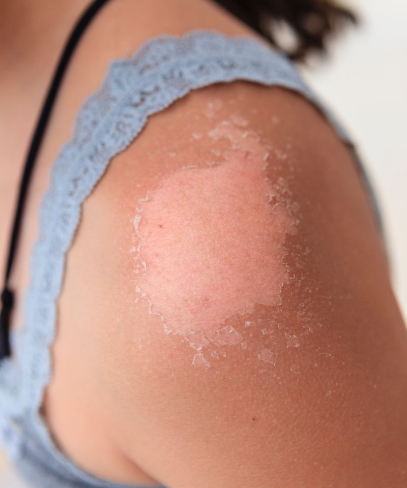 An arm/shoulder of a woman showing severe sunburn with peeling skin.