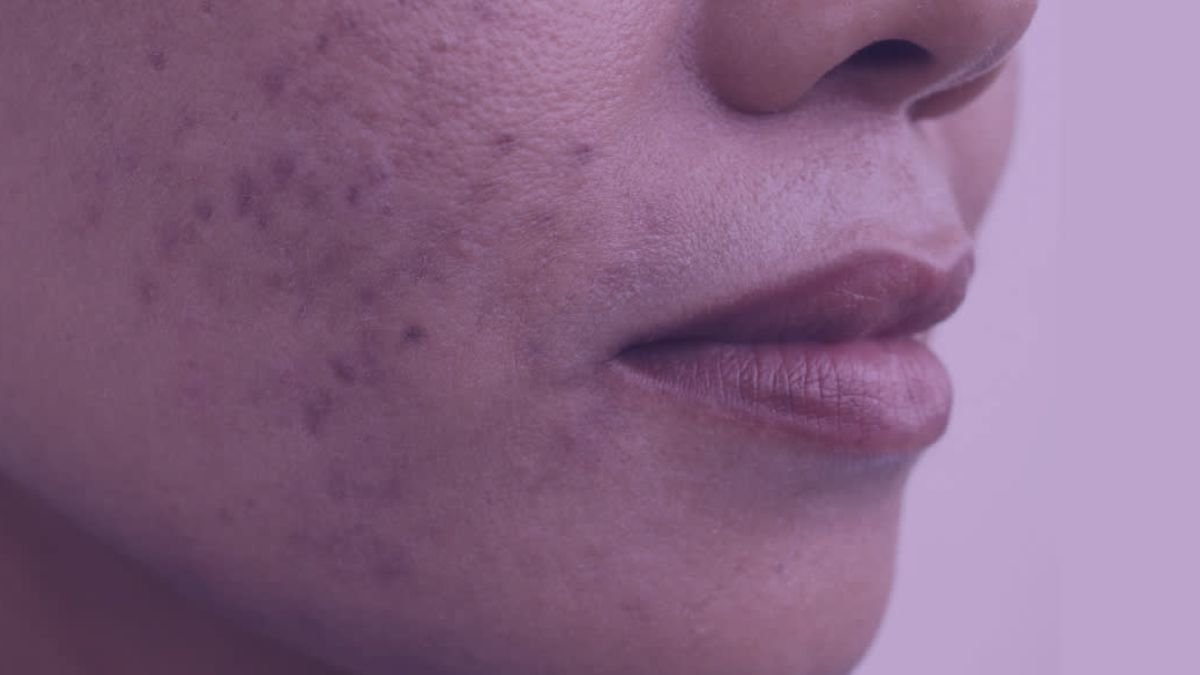 A side image of a face showing you the the symptoms of Post-Inflammatory Pigmentation and how it looks like. 