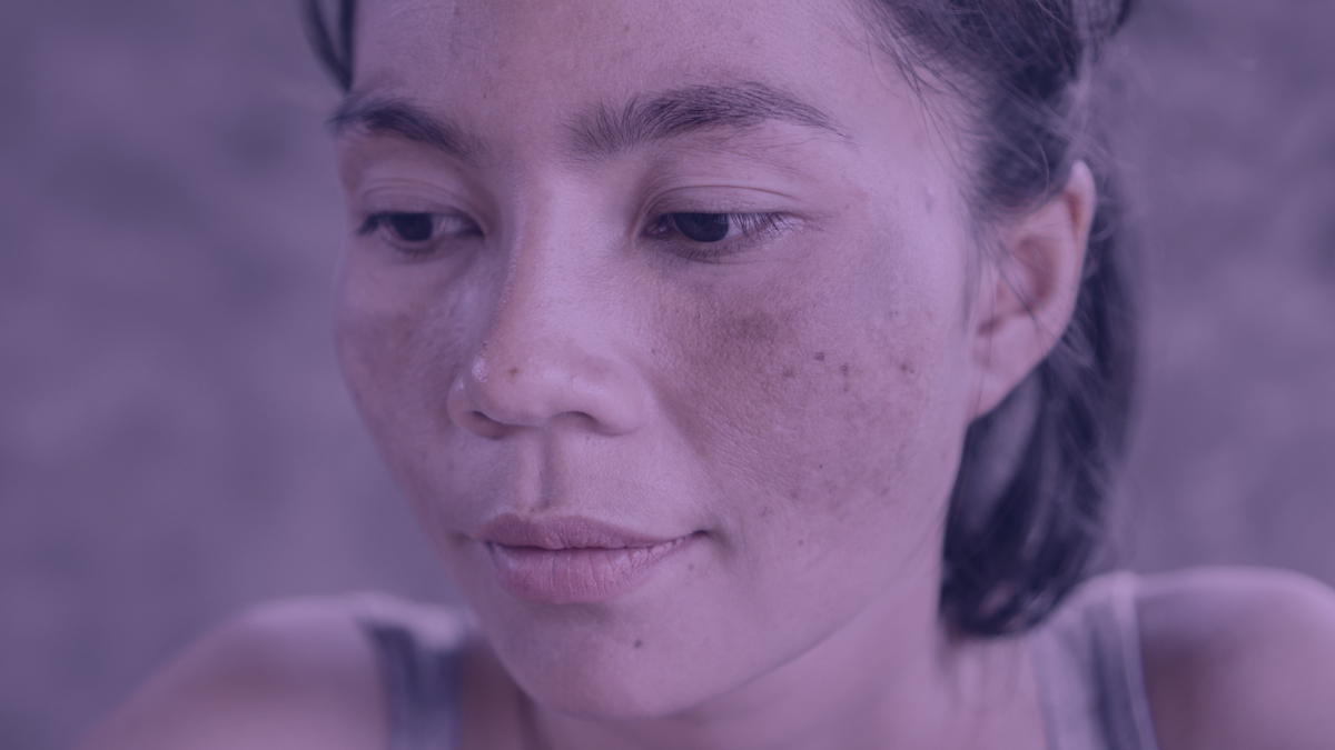 An asian lady with sun damage showing on both her cheeks, most likely sun damage with melasma.