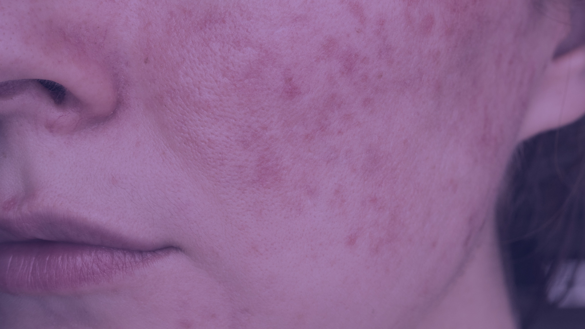 A side picture of a woman's face who is currently dealing with acne rosacea.