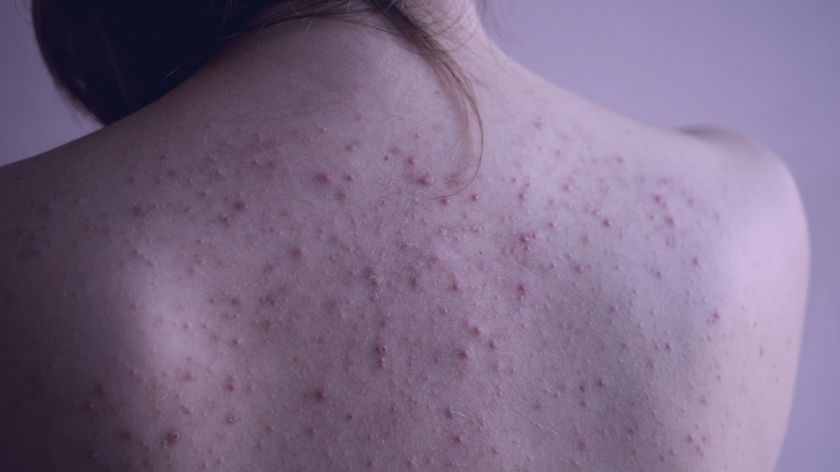 The image provides a detailed view of a person's upper back and shoulder, prominently displaying the effects of acne mechanica. This skin condition is evident through the numerous small, raised bumps spread across the pale skin. Some of these bumps exhibit a reddish tint, hinting at inflammation. The overall texture of the skin appears slightly rough because of these blemishes, giving an uneven feel. The dominant visual is the characteristic clusters of blemishes caused by acne mechanica set against a backdrop of delicate skin.
