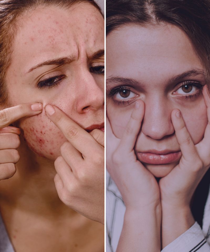 The image is a split portrait of two individuals. On the left, a person with fair skin is visibly pressing on their cheeks and chin, areas that show red acne blemishes, conveying concern or distress about their skin condition. On the right, another individual with light skin appears tired or worried, with their fingers pulling down on their eyes to possibly indicate fatigue or emotional stress. Both scenes suggest a focus on skin health and the physical manifestations of stress.