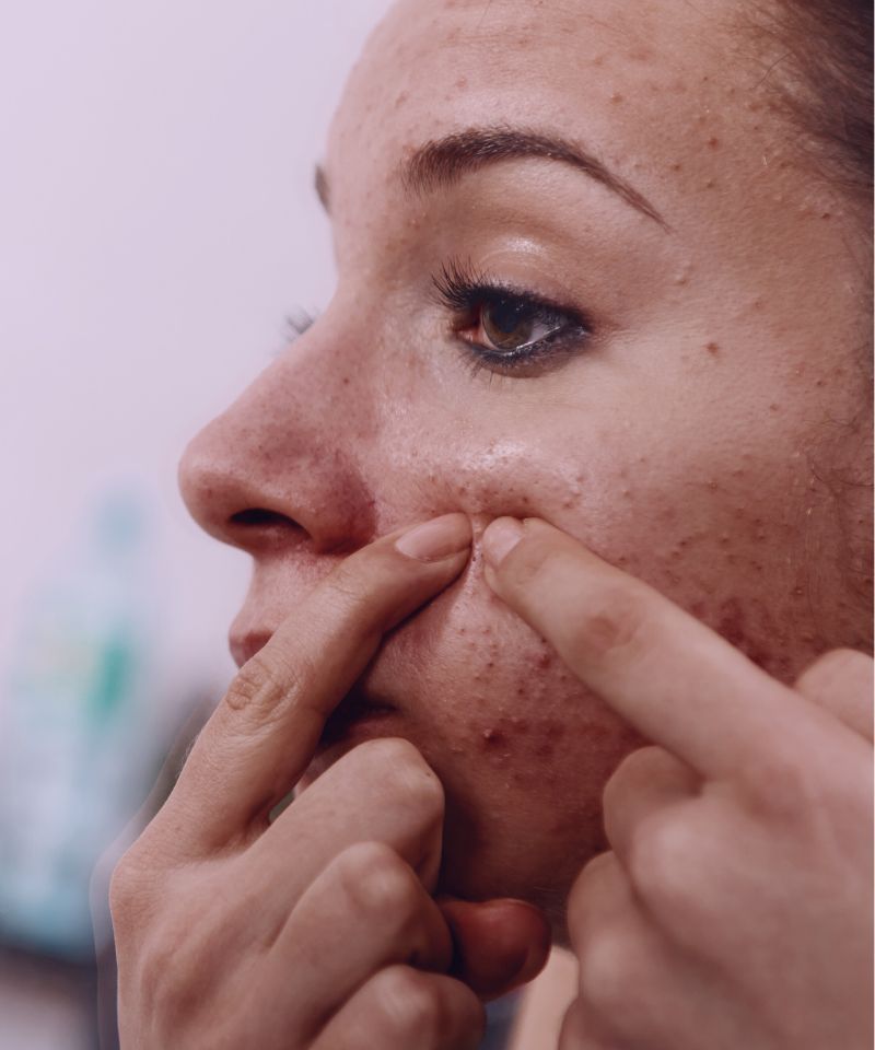 zinc deficiency may manifest as acne